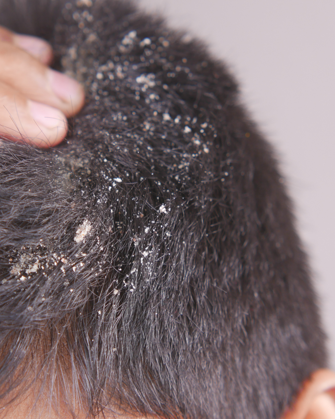 capelli forfora